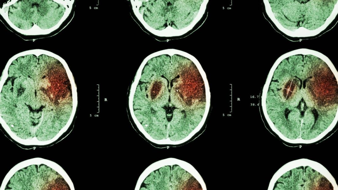 Sequência de imagens de tomografia do crânio, com uma área do cérebro destacada em vermelho